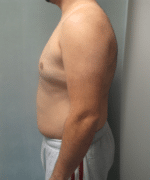 Severe Gynecomastia