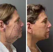 facelift-before-after