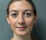 Nose Surgery (Rhinoplasty)