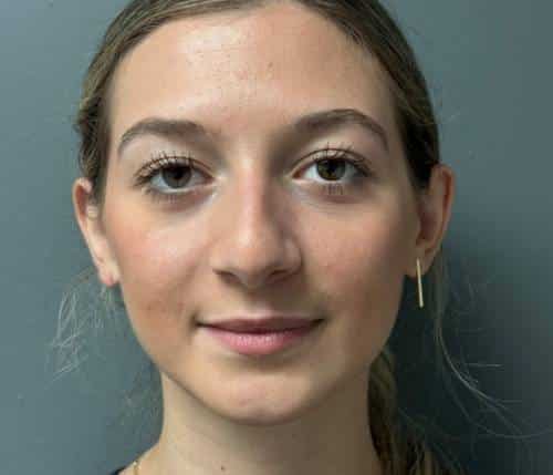 Nose Surgery (Rhinoplasty)