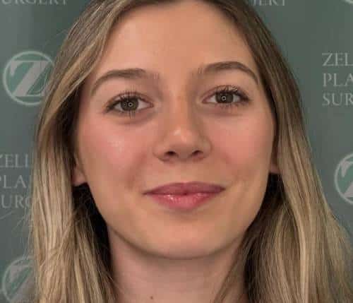 Nose Surgery (Rhinoplasty)