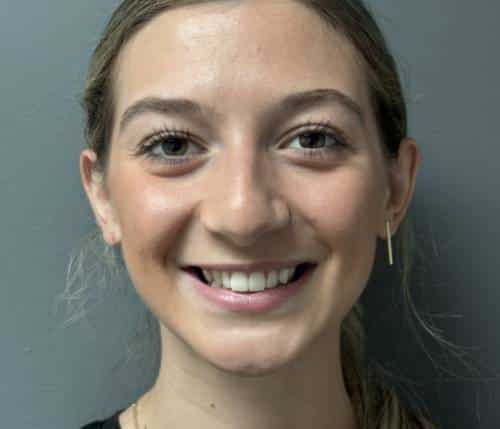 Nose Surgery (Rhinoplasty)