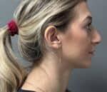 Nose Surgery (Rhinoplasty)