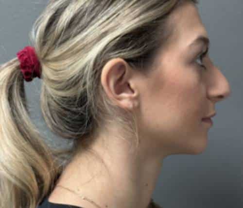 Nose Surgery (Rhinoplasty)