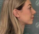Nose Surgery (Rhinoplasty)