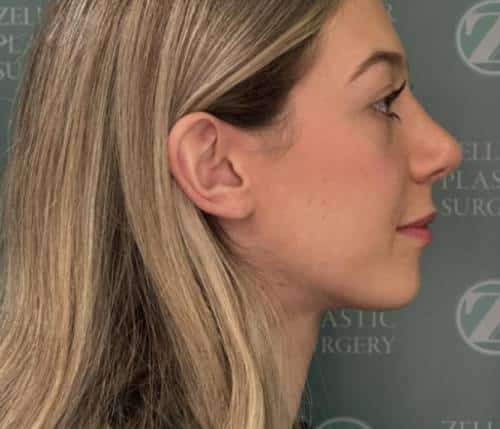 Nose Surgery (Rhinoplasty)
