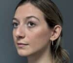 Nose Surgery (Rhinoplasty)