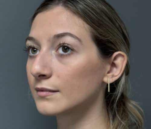 Nose Surgery (Rhinoplasty)