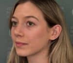 Nose Surgery (Rhinoplasty)