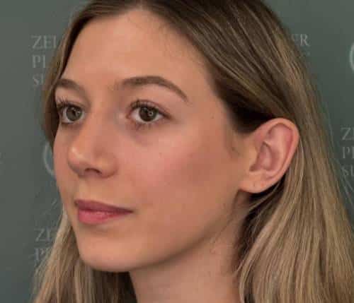 Nose Surgery (Rhinoplasty)