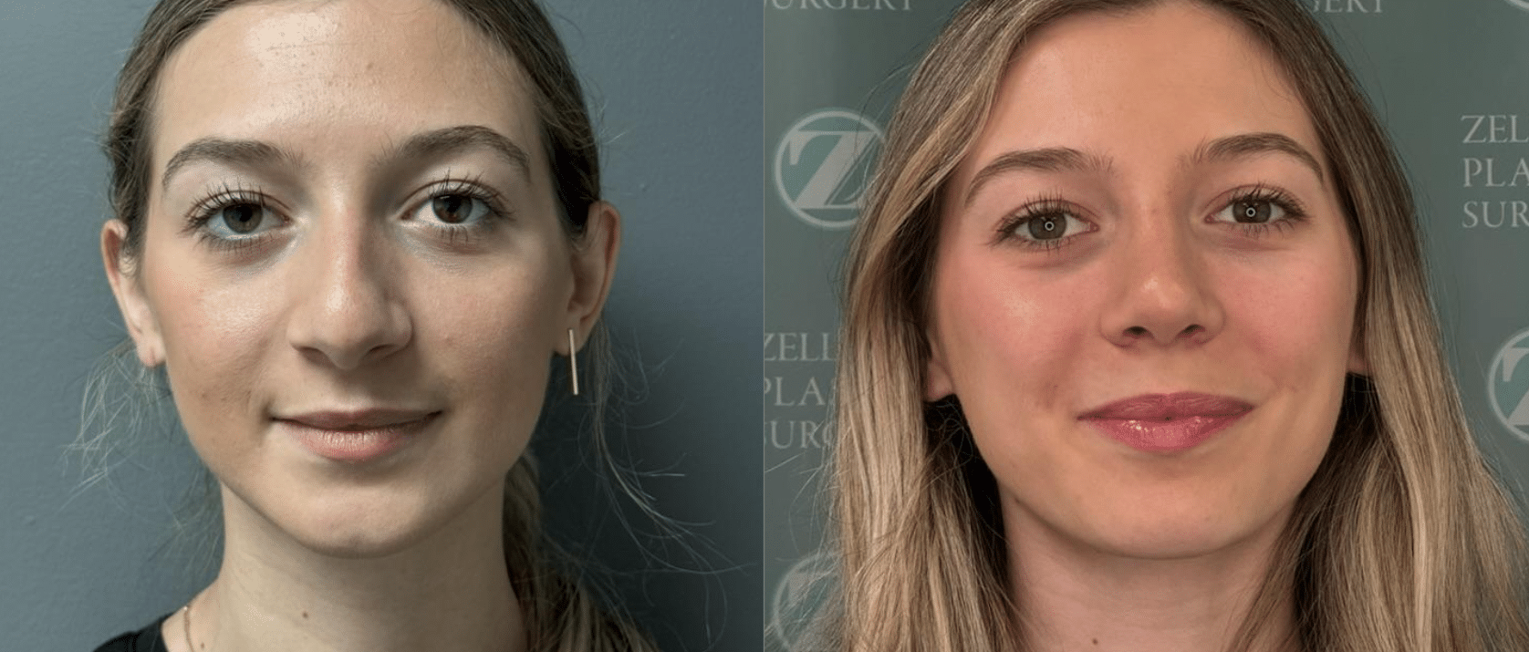 rhinoplasty before and after photo