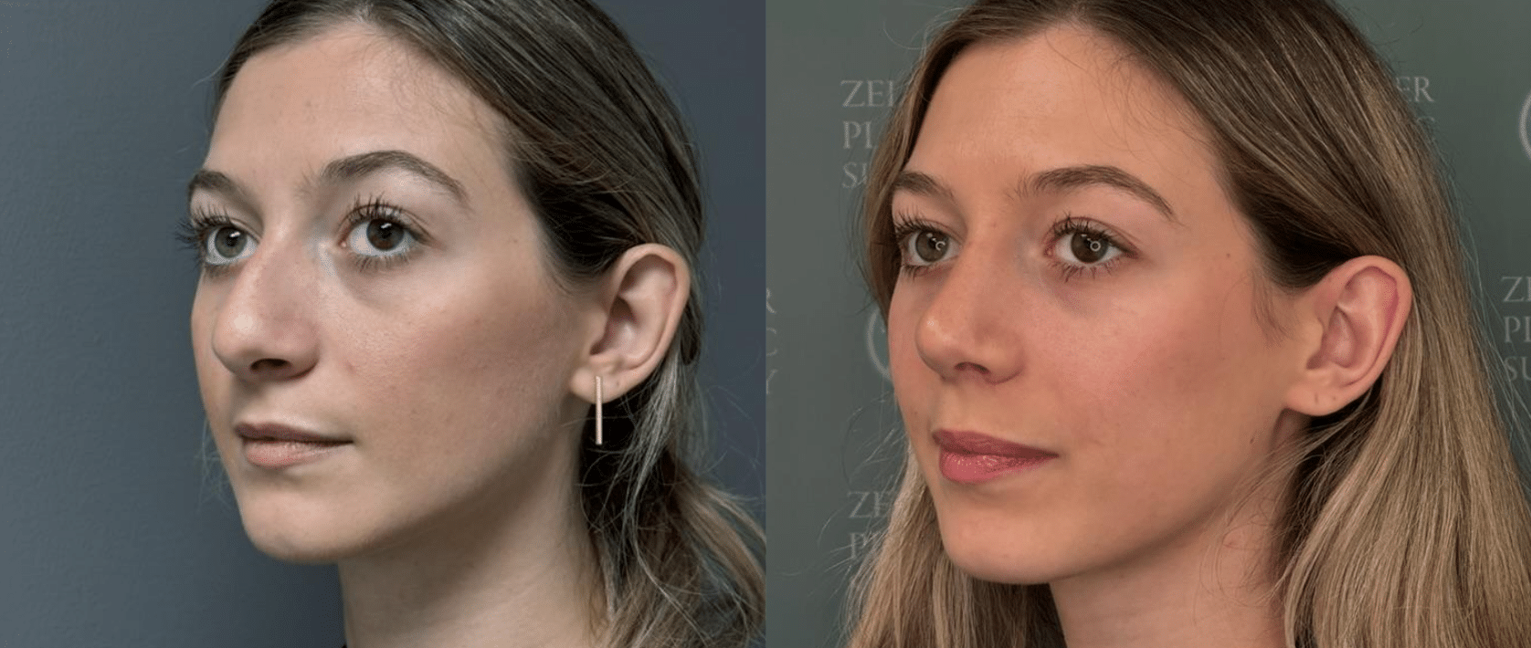 rhinoplasty before and after photo