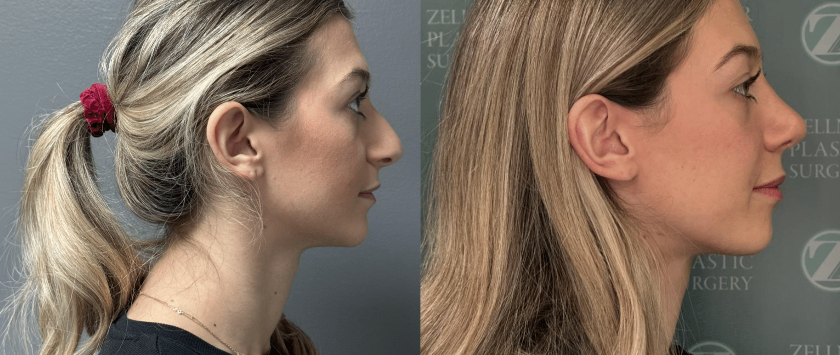 rhinoplasty before and after photo