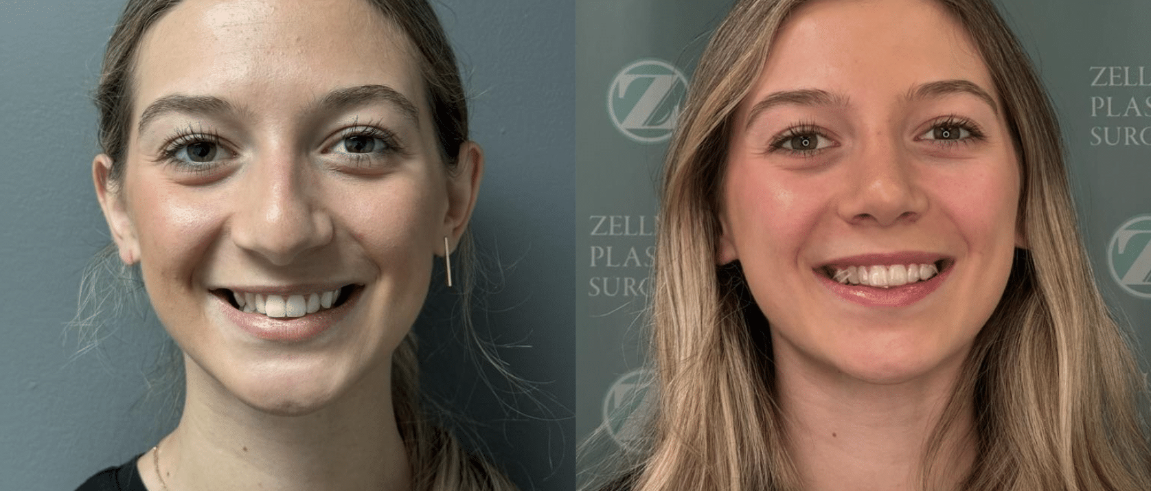 Achieving Facial Harmony and Airway Improvement with Rhinoplasty