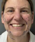 Facelift