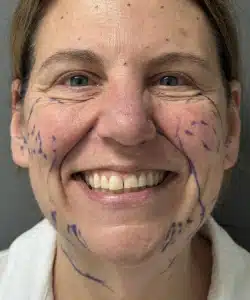 Facelift