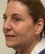 Facelift