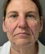 Facelift