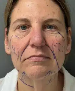 Facelift