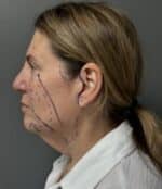 Facelift