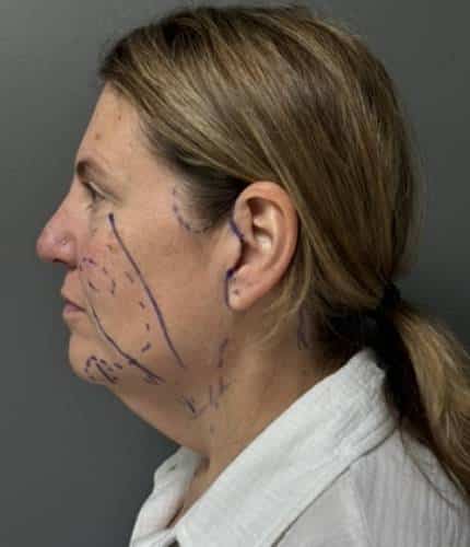 Facelift