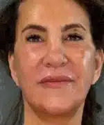 Facelift