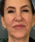 Facelift