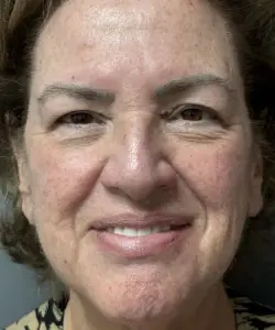 Facelift