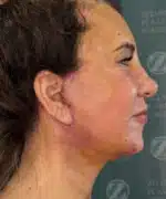 Facelift