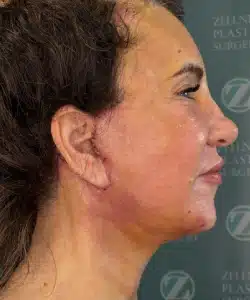 Facelift