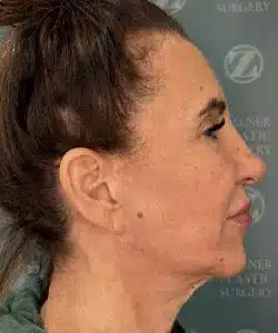 Facelift