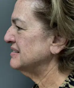 Facelift