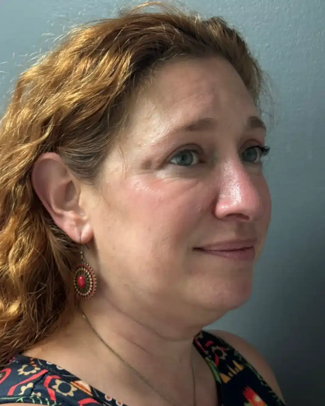 facelift before